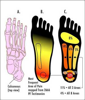 Foot pain and plantar fasciitis
